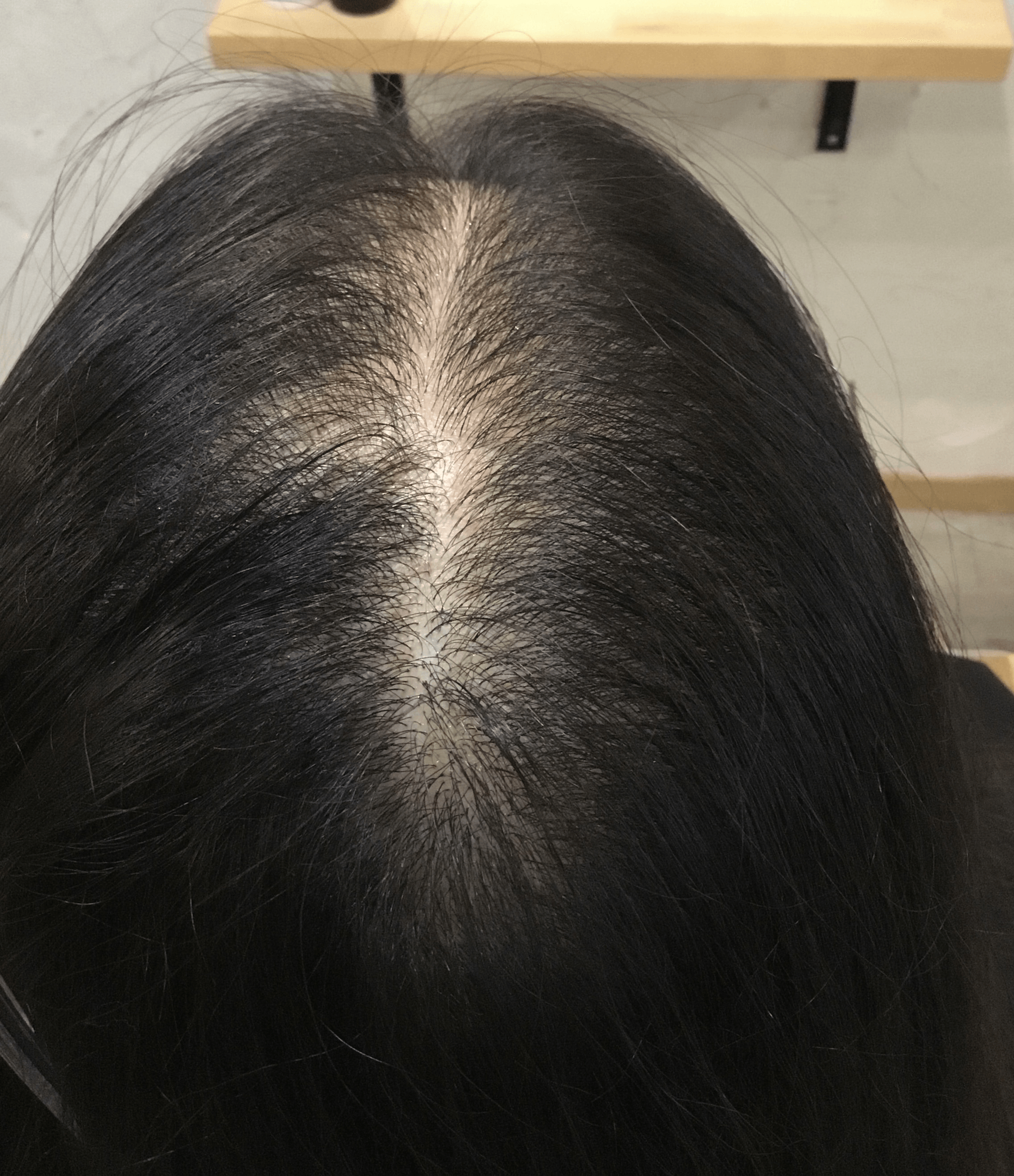 PARK練馬 頭皮ケア施術① アフター（施術後の発毛・育毛効果）