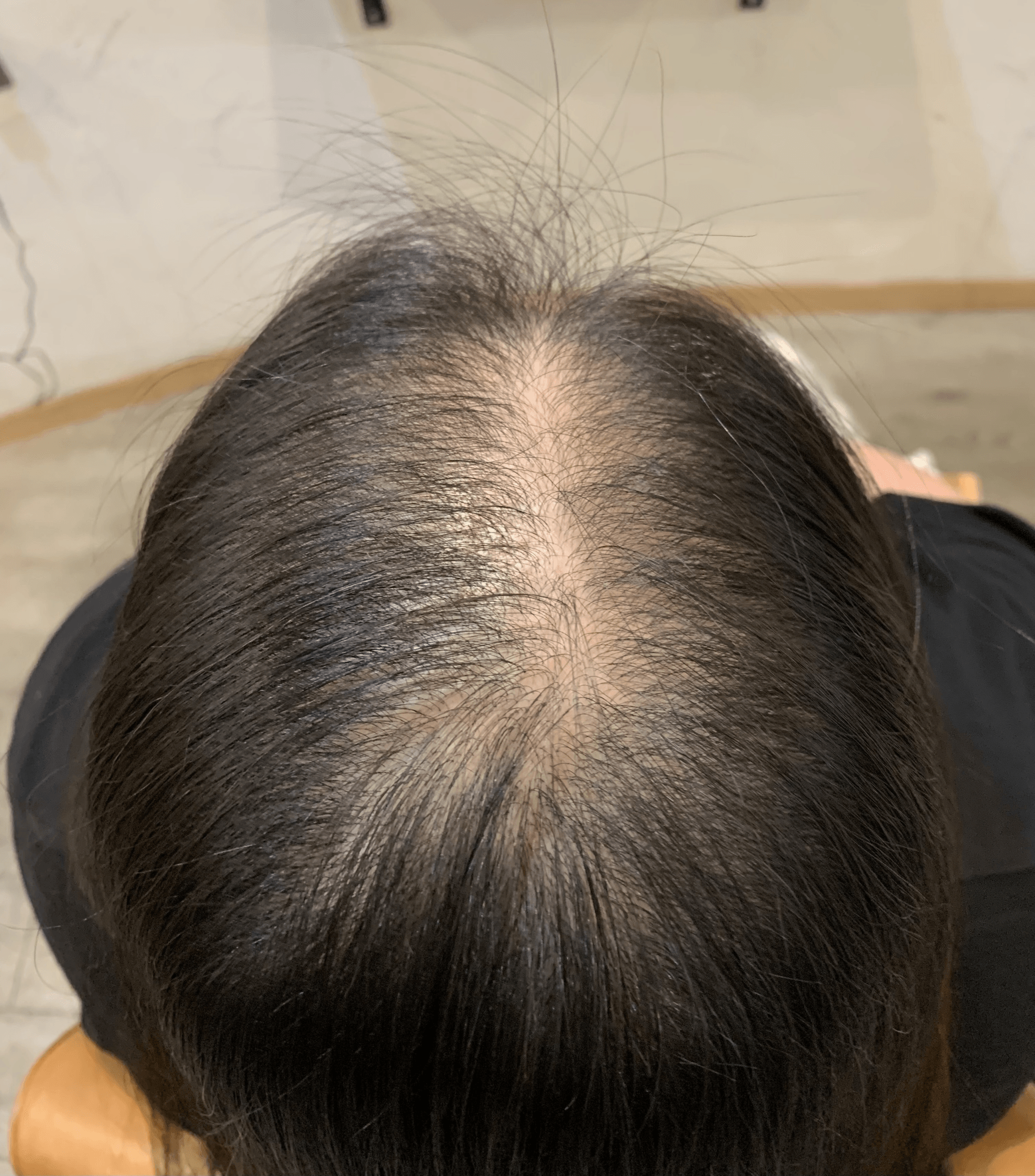 PARK練馬 頭皮ケア施術① ビフォー（施術前の頭皮・発毛状態）