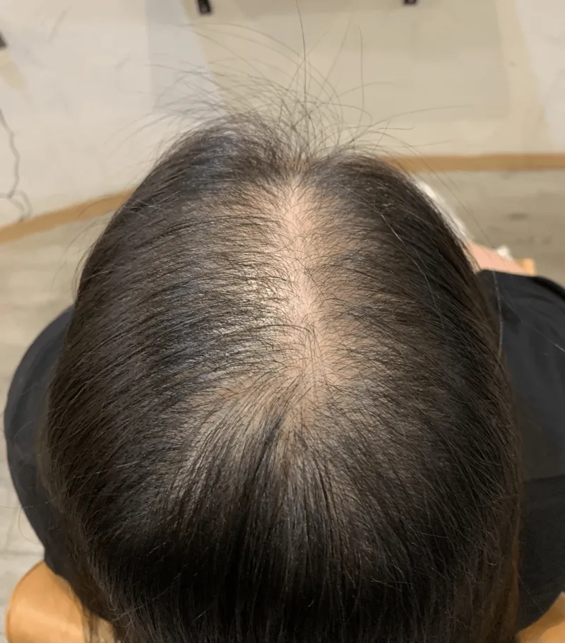 PARK練馬 頭皮ケア施術① ビフォー（施術前の頭皮の状態）