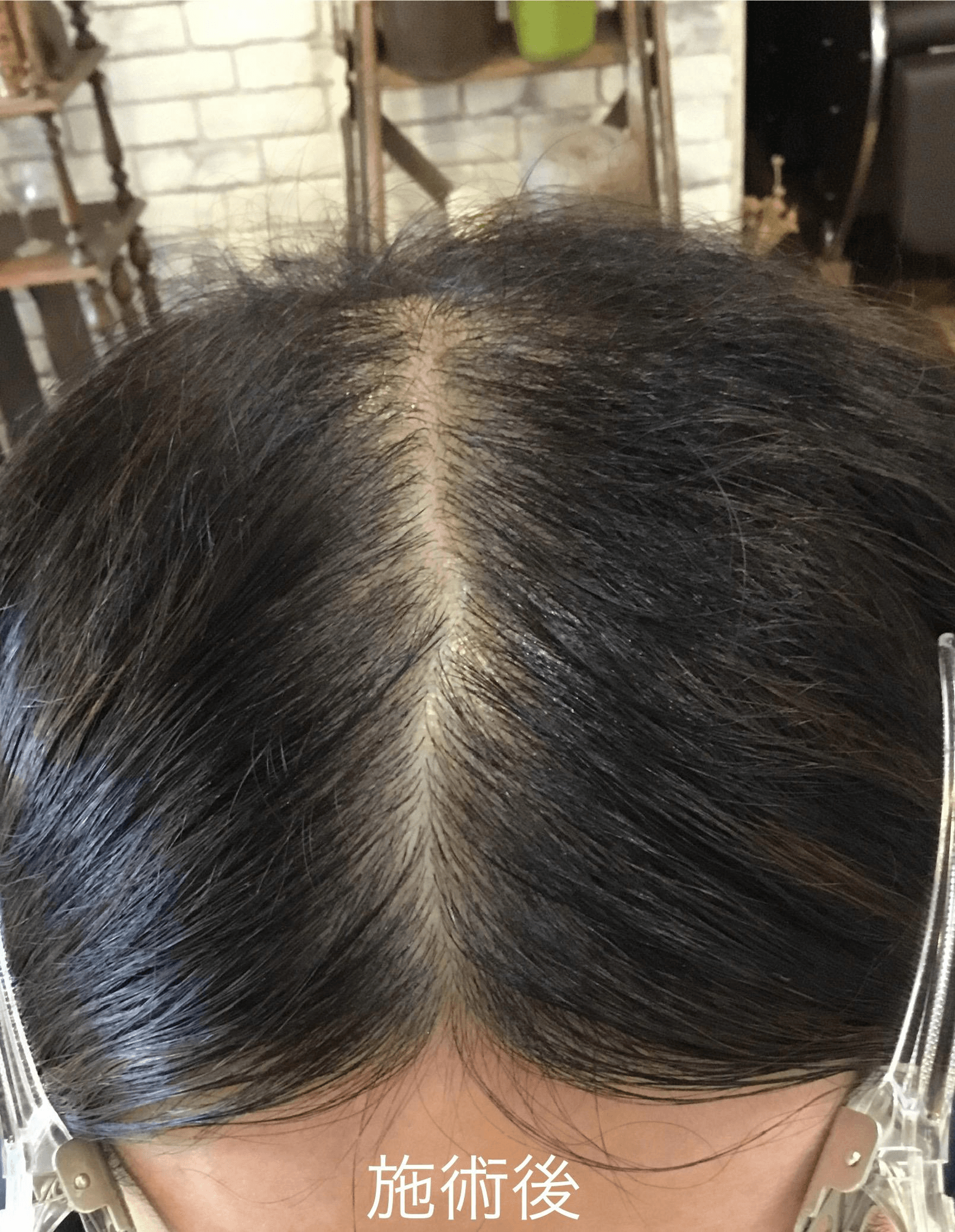PARK練馬 頭皮ケア施術② アフター（施術後の発毛・育毛効果）