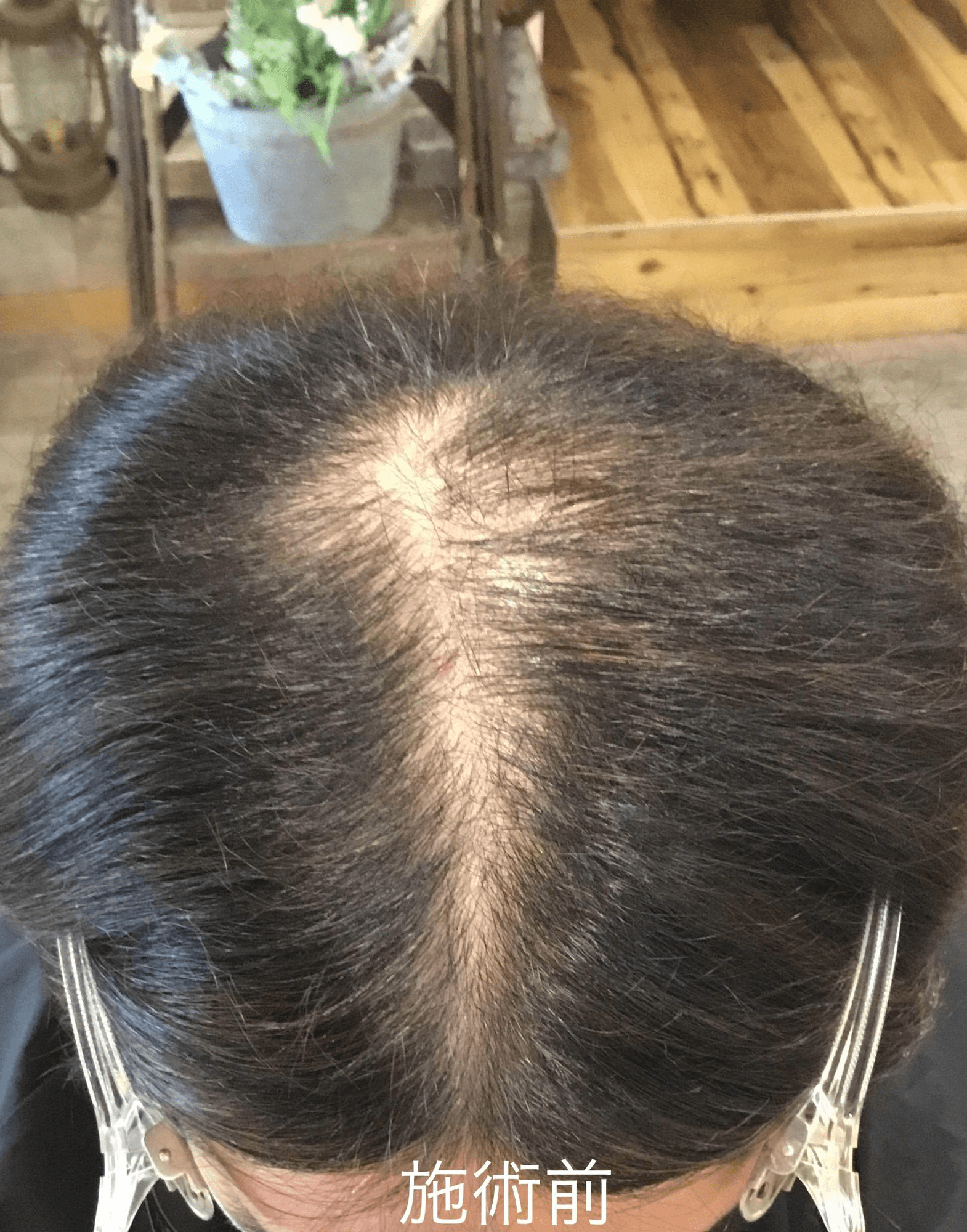 PARK練馬 頭皮ケア施術② ビフォー（施術前の頭皮・発毛状態）